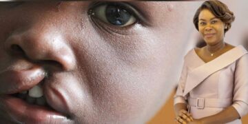 Fentes labio-palatines : une vaste campagne de consultations et d’opérations gratuites lancée au Gabon grâce à Zita Oligui Nguema